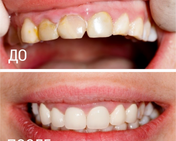 Реставрация зубов нижний новгород фото до и после
